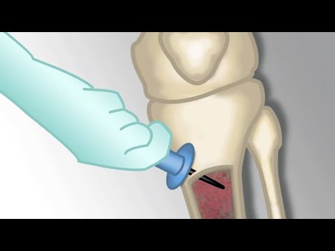Placement of an Intraosseous Line by M.Kleinman | OPENPediatrics
