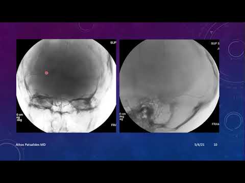 Venous Sinus Stenting
