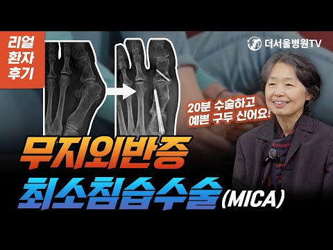 무지외반증 수술후기 - 최소침습교정수술 (MICA) "반대쪽도 빨리 수술받고 싶어요"|더서울 애프터 스토리 Ep.3 #더서울병원TV #무지외반증 #최소침습수술 #MICA #수술후기