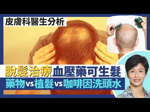 脫髮治療法|降血壓藥醫甩頭髮 生髮是副作用!?男士脫髮口服藥vs外用藥vs植髮vs咖啡因洗頭水效用分析!女性脫髮較難醫治?|王建芳醫生 皮膚科何景文醫生|人類健康研究所