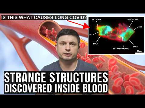 Bizarre Structures Inside Blood May Be Responsible for Long COVID
