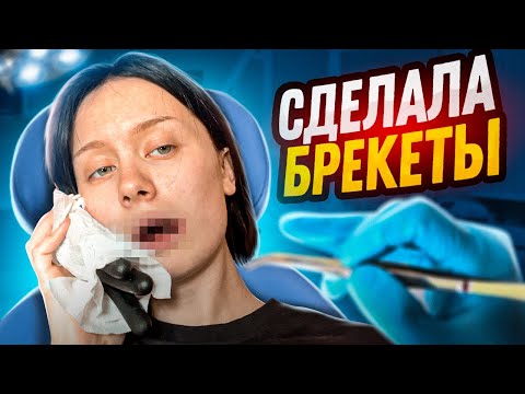 У МЕНЯ ТЕПЕРЬ БРЕКЕТЫ! (операция, гнилые зубы и боль)