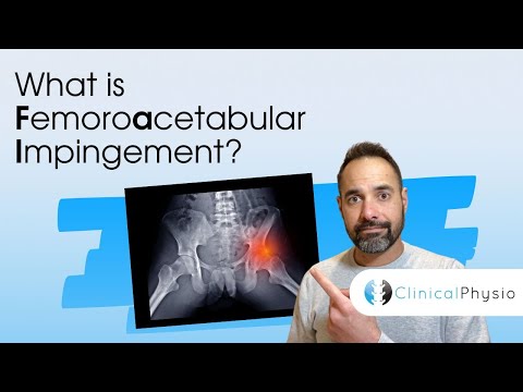What is Femoroacetabular Impingement? | Expert Physio Review