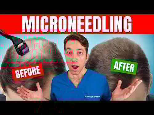 Does Microneedling Actually Regrow Hair? | Hair Surgeon's Advice