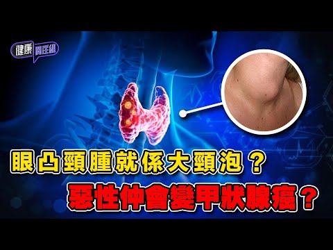眼凸頸腫就係大頸泡?惡性仲會變甲狀腺癌? | 健康關注組 | EP350 | 甲亢 | 甲減 | 大頸泡 | 甲狀腺結節 | 甲狀腺癌 | 敖嘉年 | 麥詩敏 | HOY TV 77台