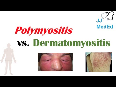 Idiopathic Inflammatory Myopathies | Polymyositis vs Dermatomyositis