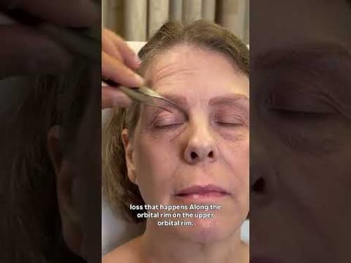Pre-Op Plan for Tami, 55: Full Facelift Transformation
