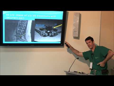 Strategies in OLIF: Tricks to Utilizing the Technique by John K. Shuster, M.D.