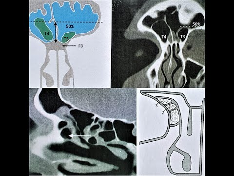 KUHN'S CLASSIFICATION | AGGER NASI | FRONTAL CELLS | SUPRA-BULLAR CELL | FRONTO-BULLAR CELL