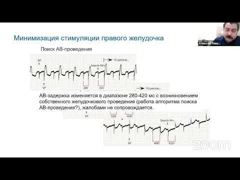 ЭКГ феномены работы алгоритмов современных кардиостимуляторов при холтеровском мониторировании