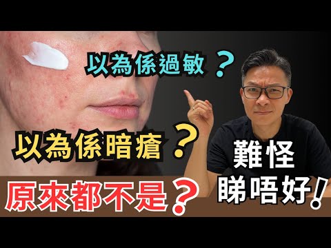 以為皮膚暗瘡過敏,搽類固醇,一發不可收拾。原來玫瑰痤瘡!專家教你根治病因! #青春期暗瘡 #玫瑰痤瘡 #皮膚過敏 #暗瘡 #類固醇 #細胞訊號