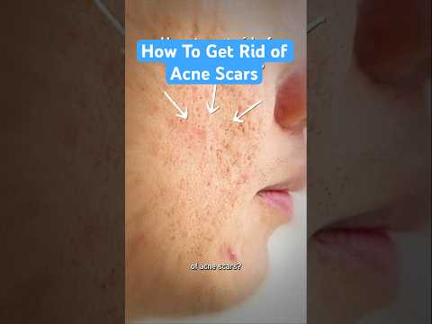 How To Get Rid of Acne Scars