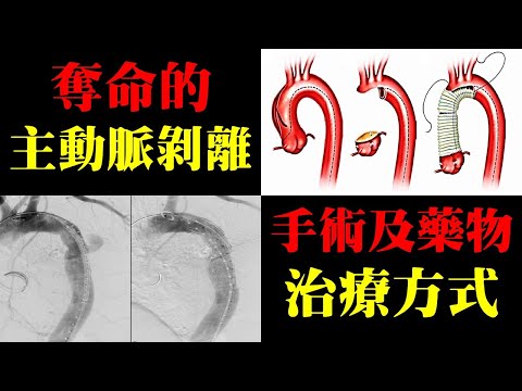 奪命的主動脈剝離,手術及藥物的治療方式|許原彰醫師