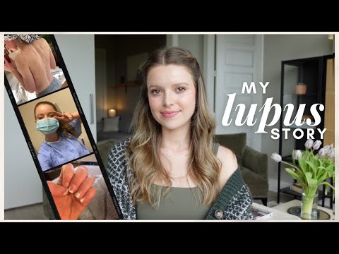 My Lupus Diagnosis Story (Symptoms, Testing, Treatment)
