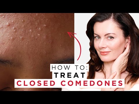 How To Treat Closed Comedones | Dr Sam Bunting