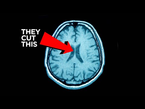 The Surgery That Proved There Is No Free Will