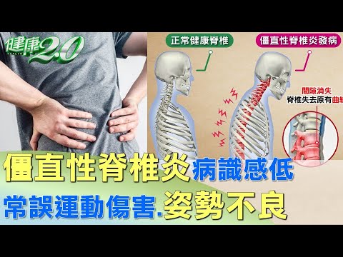 僵直性脊椎炎病識感低 常誤運動傷害.姿勢不良 健康2.0 @tvbshealth20