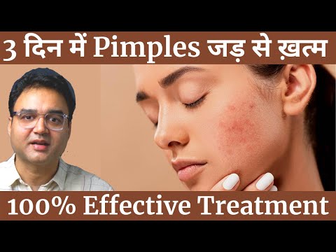 Pimples को बोलो अलविदा | 4 Simple Steps To Remove Pimples & Get Clear, Spotless Skin (Naturally)