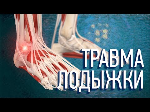 Растяжение лодыжки. Какие упражнения делать? Как восстанавливаться?