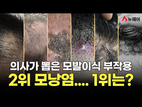 모발이식 부작용의 모든 것이 궁금하다면?! 필수시청