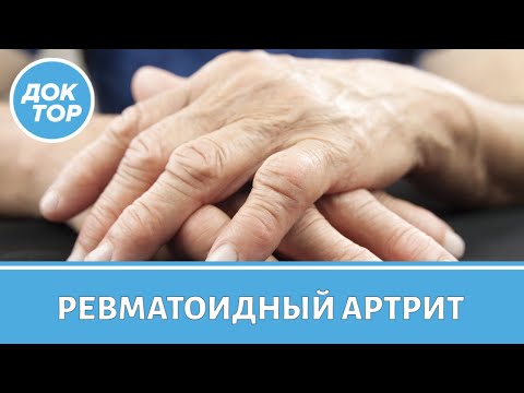 Ревматоидный артрит | Причины появления, симптомы, лечение