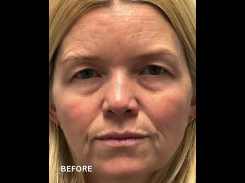 Before & After Endoscopic Brow Lift + Upper Eyelid Blepharoplasty | Dr. Kian Eftekhari