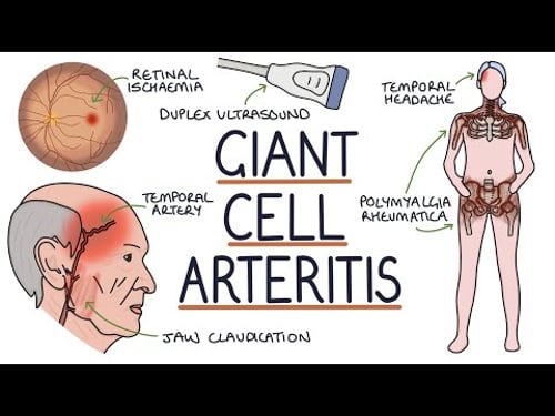 Understanding Giant Cell Arteritis (Temporal Arteritis)