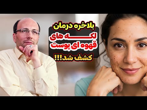 چگونه لکه های قهوه ای پوست را از بین ببریم؟