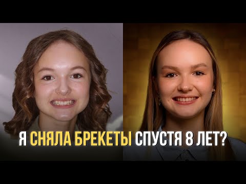 МОЯ ИСТОРИЯ С БРЕКЕТАМИ | ПОЧЕМУ 8 ЛЕТ?