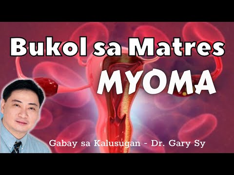 Myoma: Uterine Fibroids - Dr. Gary Sy