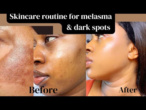 How I cleared my Melasma & Hyperpigmentation