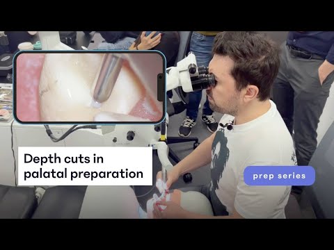 Depth cuts in palatal preparation