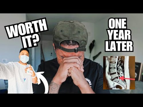 ONE YEAR LATER...WAS MY SPINE SURGERY WORTH IT? (MY L5/S1 MICRODISCECTOMY RECOVERY EXPERIENCE)