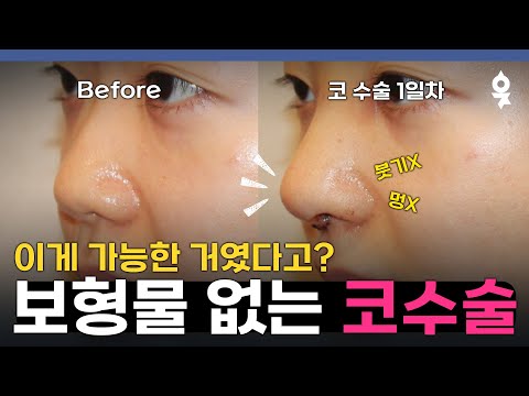 Silicone❌ Nose Surgery: Get Back to Your Daily Life Right Away! The Secret to a Beautiful Nose Su...
