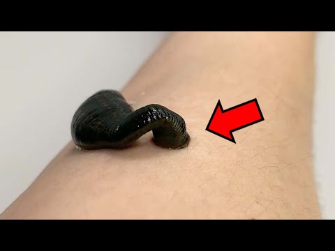 거머리에게 물린 부위에는 특이한 무늬가 나타납니다 ㄷㄷ