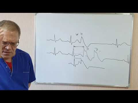 Экстрасистолическая аритмия, пароксизмальные тахикардии, фибрилляция и трепетание предсердий.