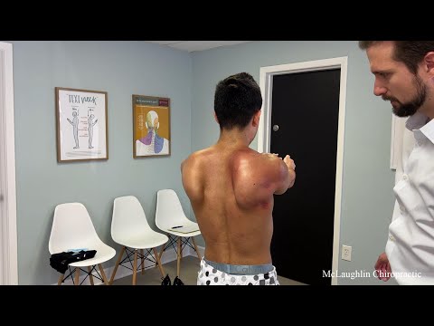 The MOST Severe WINGED SCAPULA I've Ever SEEN 😳 Huge Scapula Knots & Nerve Damage In 20 Year Old