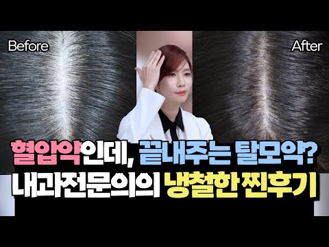 혈압약을 먹었더니 탈모가 치료됐어요. 내과전문의가 직접 복용하고 알려주는 미녹시딜