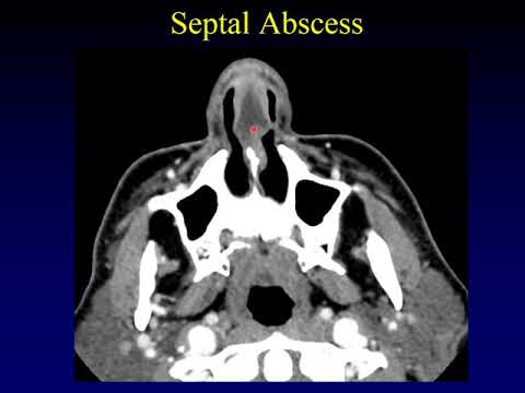 Imaging of the Paranasal Sinuses 3