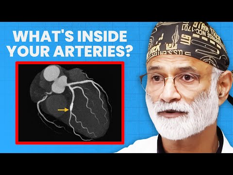 How to Find Clogged Arteries (Cardiologist Explains) | Dr. Pradip Jamnadas
