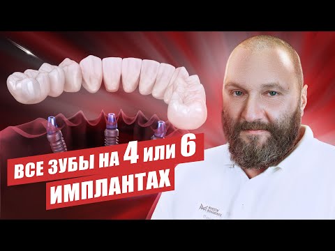 🇺🇦 Имплантация «все на 4 и 6» имплантах — в чем отличие