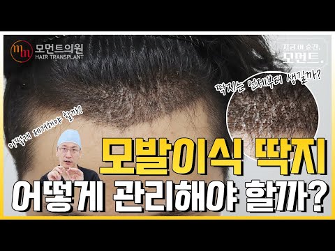 모발이식 딱지 어떻게 관리해야 할까? 제거하는 법, 관리법 😧 l 김경복원장 l 모먼트의원(MOMENT) l 히든컷