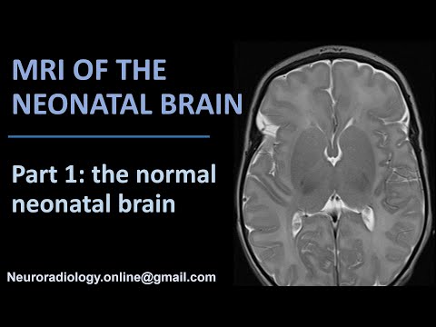 MRI of the Neonatal Brain, part 1: the normal neonatal brain.