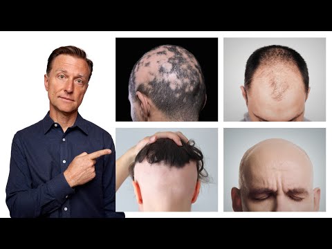 The 11 Types of Alopecia (AND HOW TO FIX IT) - Dr. Berg