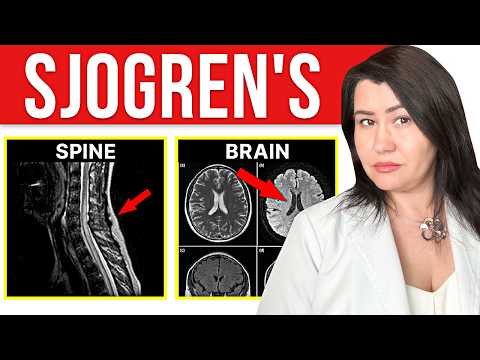 How SJOGREN'S Syndrome Affects Your BRAIN & Spine: Rheumatologist Explains