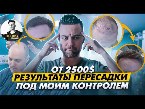 Пересадка волос ПОД КЛЮЧ под моим личным контролем в 2025 от 2500$\ KRASAV4IK