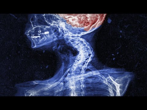 A Mom Did Chiropractic Maneuver On Her Own Neck. This Is What Happened To Her Brain.