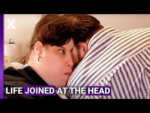 Life of the World’s Oldest Conjoined Twins