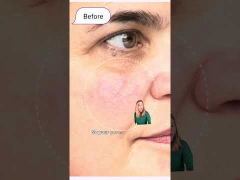Redness and inflammation makes your pores look bigger! Here’s how to fix it from DERM