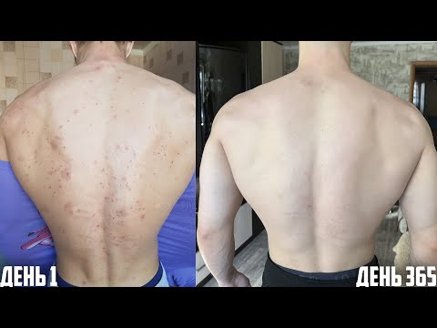 365 DAYS OF AKNEKUTAN or HOW TO TREAT ACNE AND GET RID OF PIMPLES? THIS IS WHAT HAPPENED!